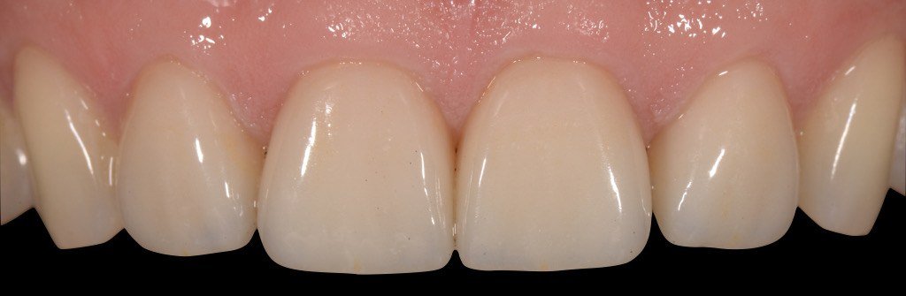 Case one, after treatment: rebuilt upper front teeth with even edges and natural shape.