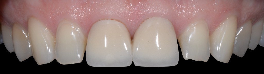 Case one, before treatment: worn upper front teeth with uneven edges.