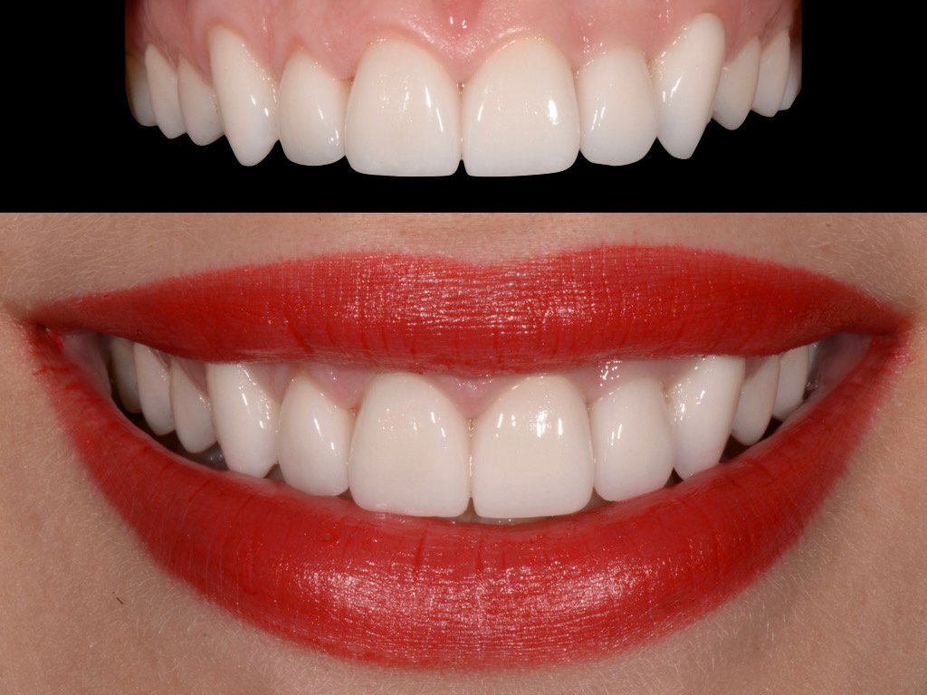 Case two, a different patient: the finished smile after treatment at a partner clinic.
